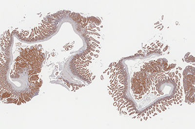 Polyp B Catenin